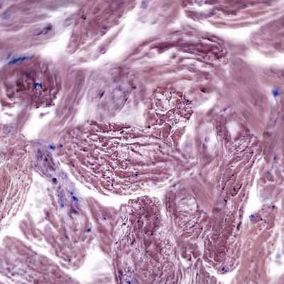 Image of pink-coloured cancer cells